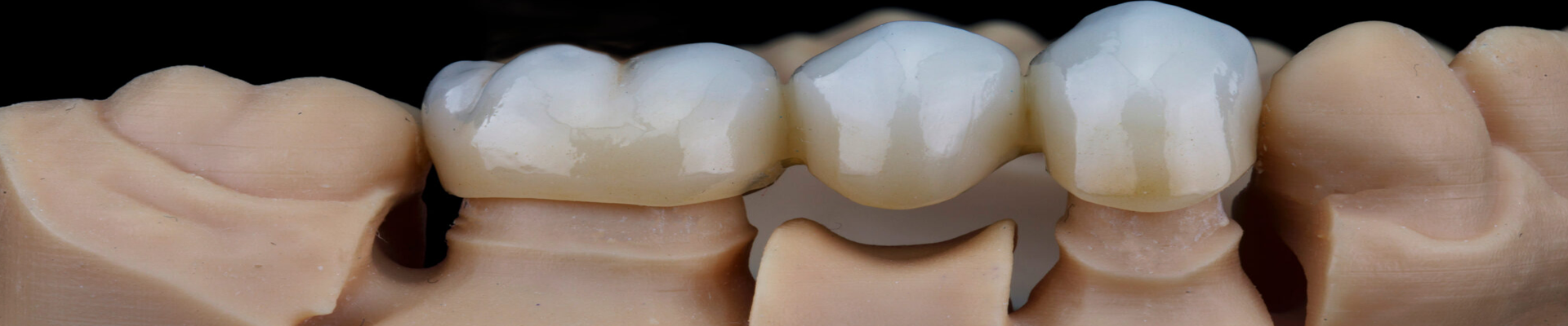 Dental Bridges